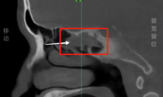 
        		男子鼻痛18年疑骨瘤 开刀取出3cm树枝 !	